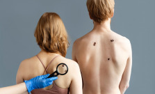 Čo je keratóm a ako ho vyliečiť?